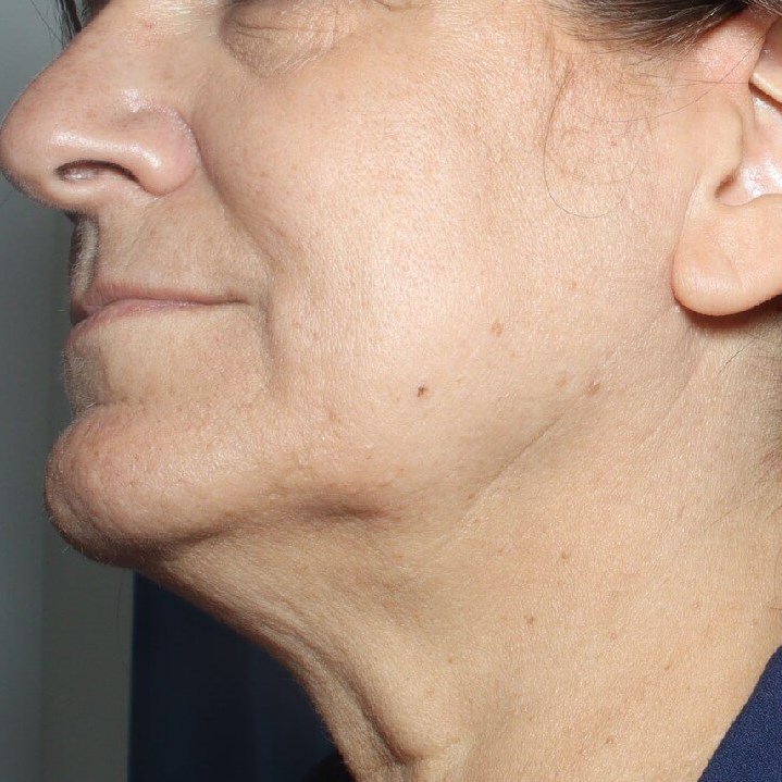 Pre op Phase 2 Limted Necklift